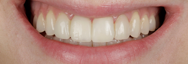 After - Ibbott Dental 