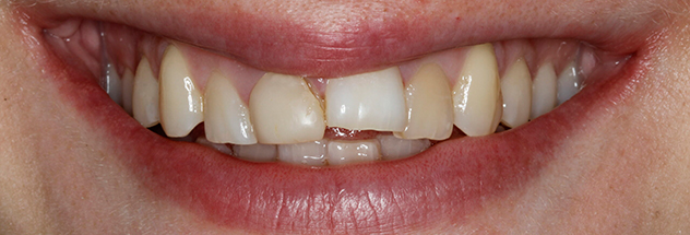 Before - Ibbott Dental