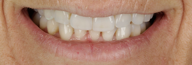 After - Ibbott Dental 