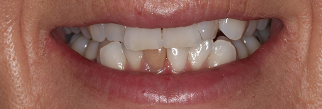 Before - Ibbott Dental