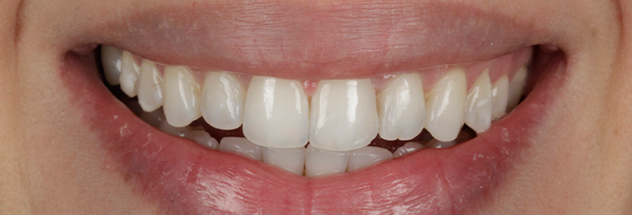 After - Ibbott Dental 