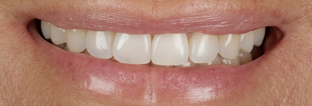 After - Ibbott Dental 