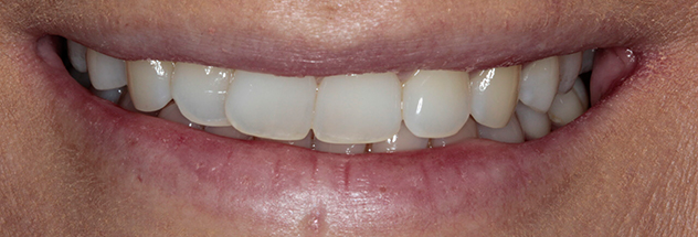 Before - Ibbott Dental