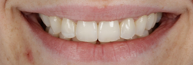 After - Ibbott Dental 