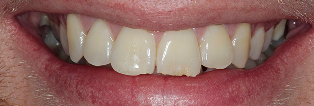 Before - Ibbott Dental