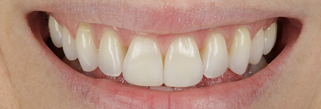 After - Ibbott Dental 