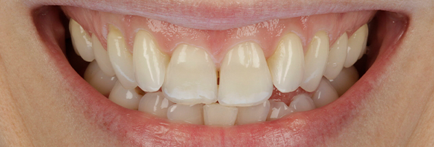 Before - Ibbott Dental