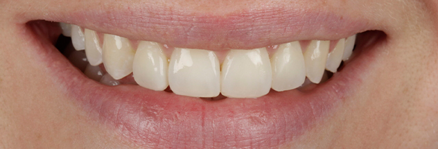 After - Ibbott Dental 