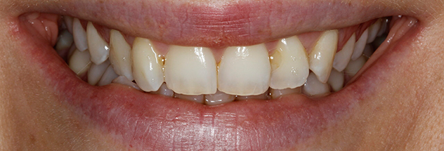 Before - Ibbott Dental