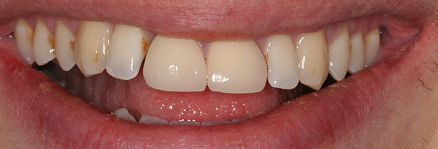 Before - Ibbott Dental