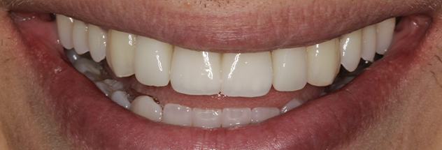 After - Ibbott Dental 