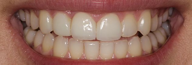 After - Ibbott Dental 