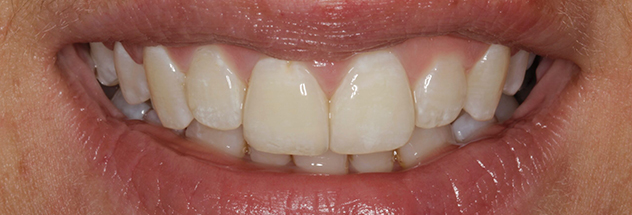 After - Ibbott Dental 