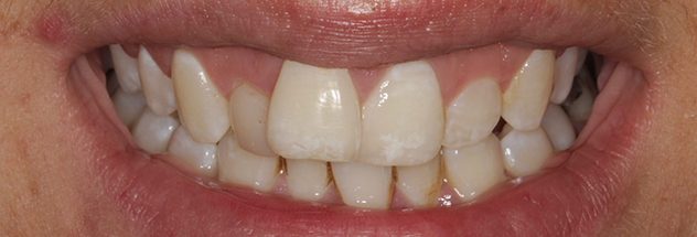 Before - Ibbott Dental