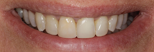 After - Ibbott Dental 