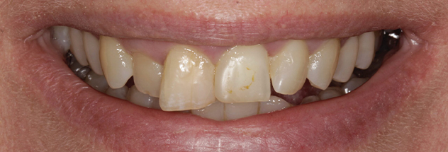 Before - Ibbott Dental