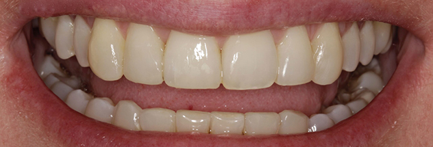 After - Ibbott Dental 