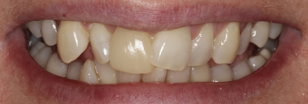 Before - Ibbott Dental