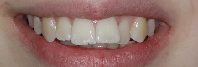 Before - Ibbott Dental