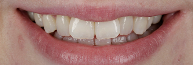 Before - Ibbott Dental