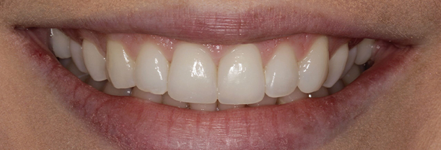 After - Ibbott Dental 