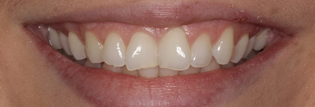 Before - Ibbott Dental