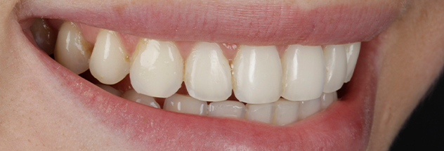 After - Ibbott Dental 