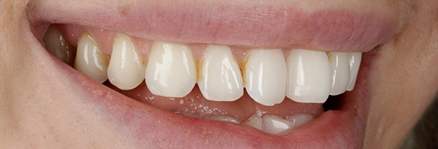 Before - Ibbott Dental