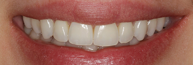 After - Ibbott Dental 