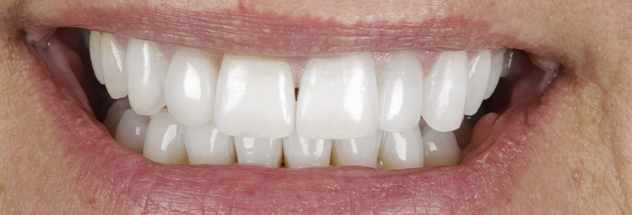 After - Ibbott Dental 