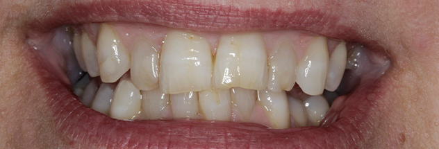 Before - Ibbott Dental